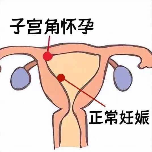 注意啦！胎宝宝在这里“安家”比宫外孕更凶险