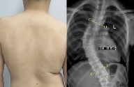 “吊单杠”“搞正骨”就行了？脊柱侧弯的治疗雷区你踩了多少？