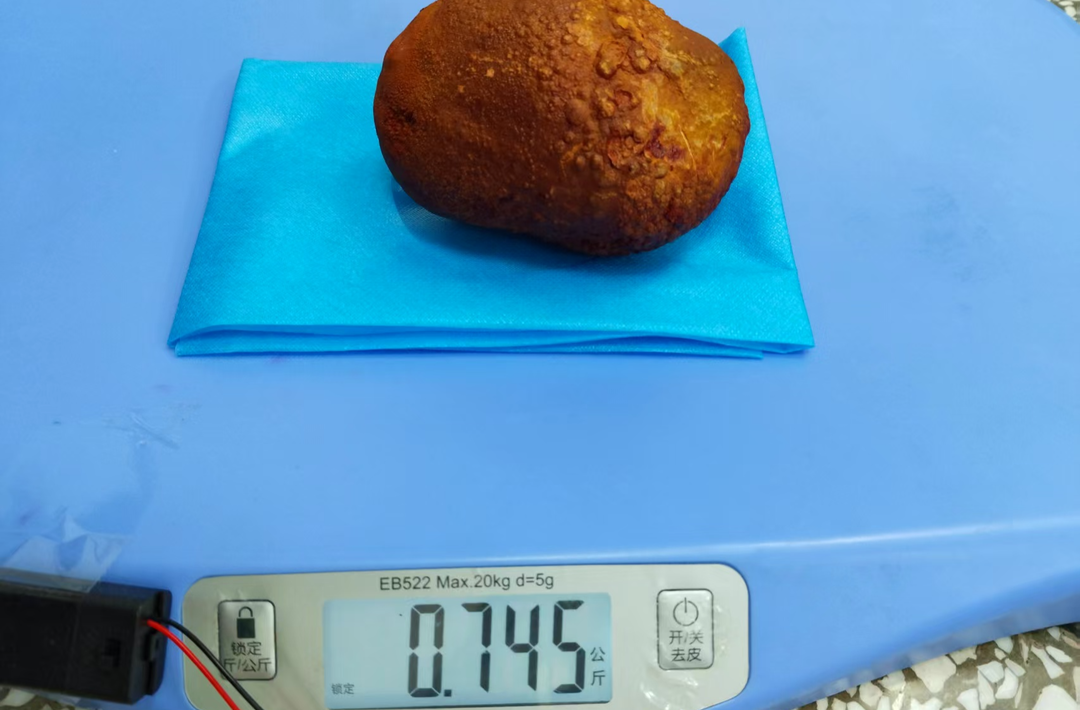 娄底市第二人民医院为七旬老人取出巨大膀胱结石