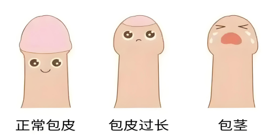 男孩包皮“收割季”已至——割不割？怎么割？家長需見“雞”行事！