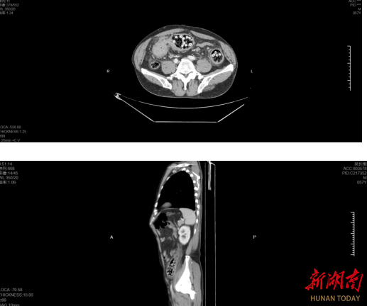 兩斤楊梅連核吞下致腸穿孔 手術(shù)意外揪出結(jié)腸腫瘤