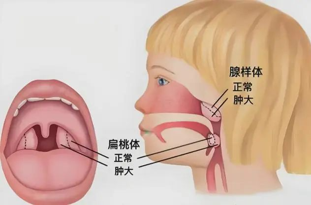 千萬別等！這病正在“偷走”孩子的美貌和智商，暑假是黃金治療期