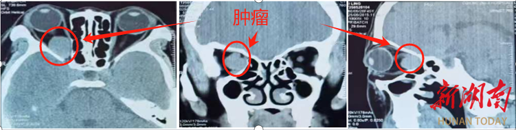 90%失明風險下的“光明突圍”：鼻內(nèi)鏡微創(chuàng)技術(shù)攻克眶尖腫瘤