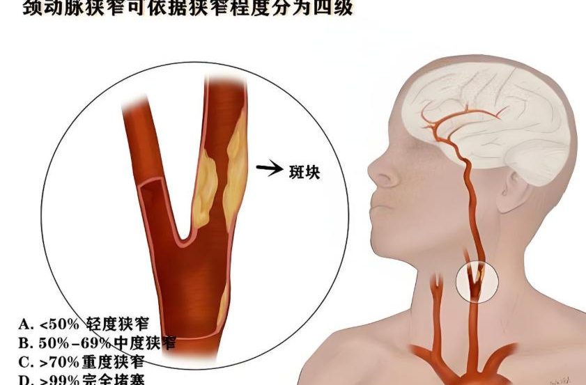 頸動脈斑塊不痛不癢就不用管？這個錯誤認知差點讓他癱瘓！