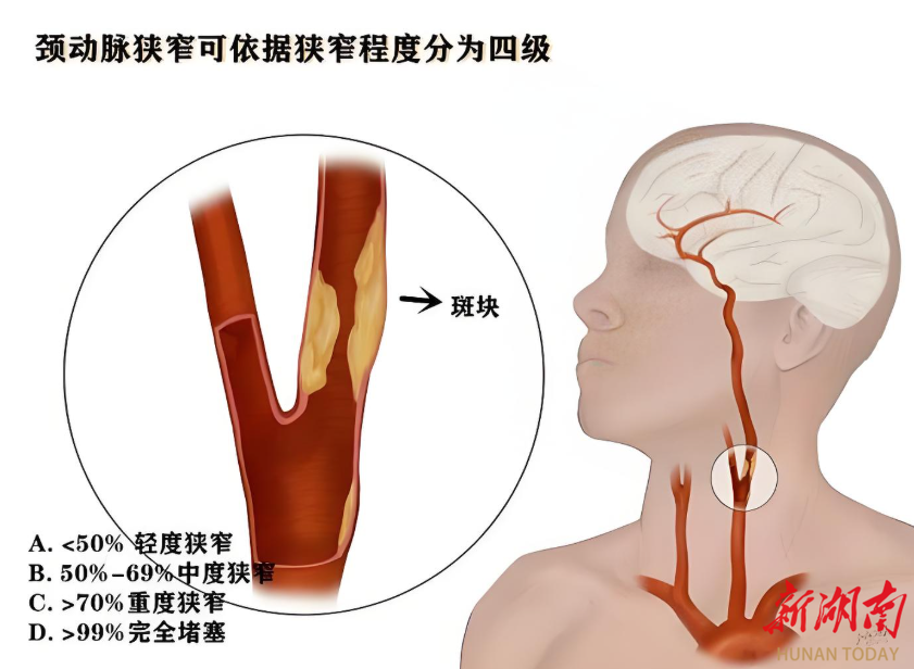 頸動(dòng)脈斑塊不痛不癢就不用管？這個(gè)錯(cuò)誤認(rèn)知差點(diǎn)讓他癱瘓！