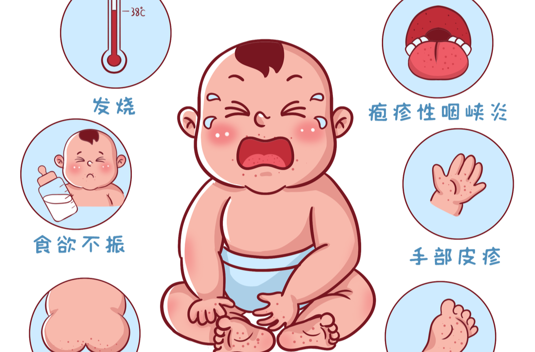 夏季高发，这样科学应对手足口病
