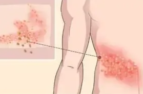高温天，“蛇缠腰”易发病 专家：慢性病患者要主动预防
