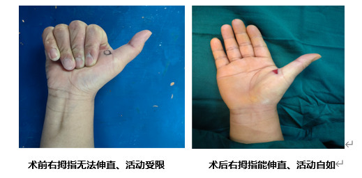 手機刷不停，當心“扳機指”找上門！