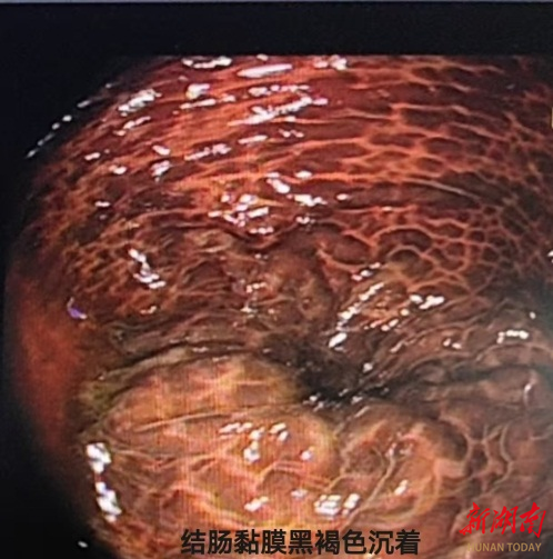 通便药当“减肥药”长期服用，37岁女子吃出结肠黑变病
