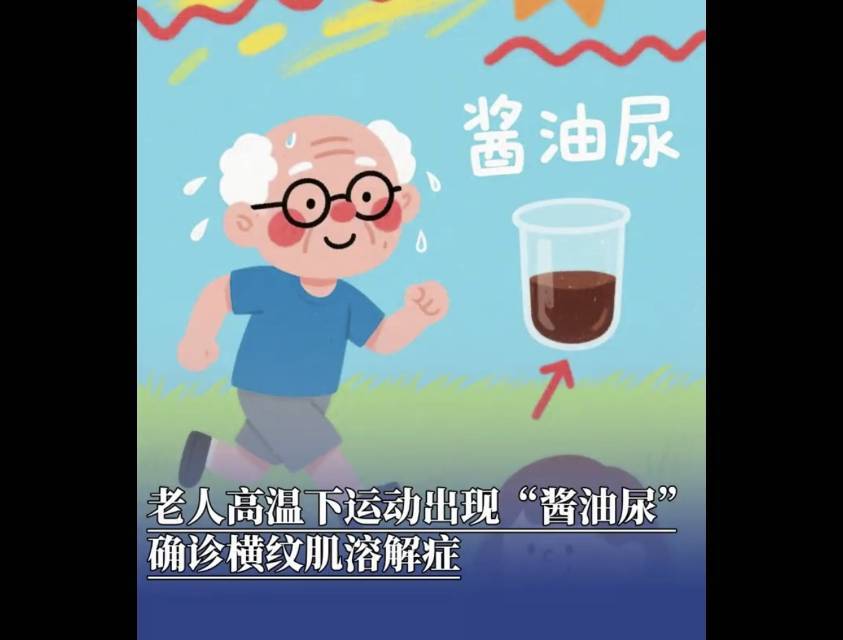 60岁老人高温下剧烈运动，确诊横纹肌溶解症