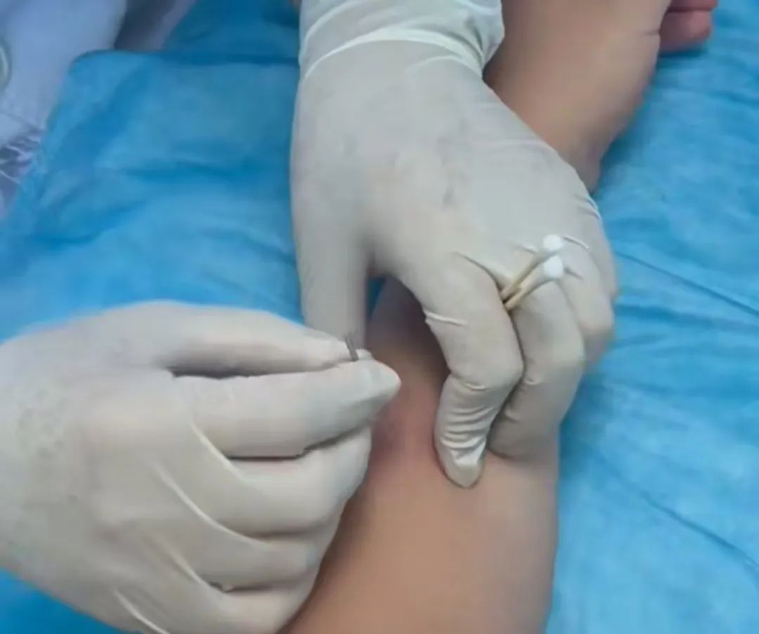 孕期遭遇腱鞘炎不用愁 衡陽(yáng)市中醫(yī)醫(yī)院微針技術(shù)為孕媽解憂