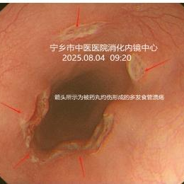 小疏忽藏大风险！食道灼伤、鱼骨卡喉事件频发，这些土办法千万别用