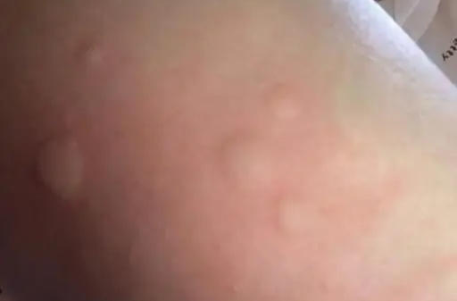 蚊子包“越抓越大”？可能是急性荨麻疹作怪