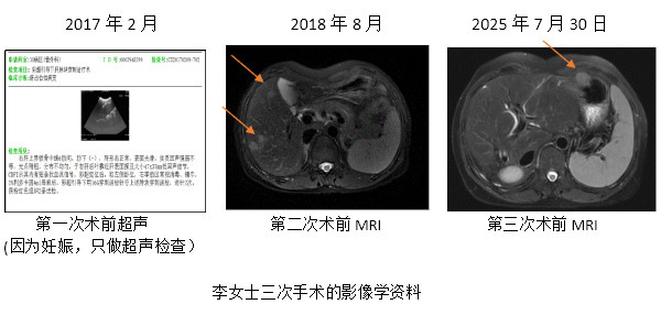 肝癌女子8年历经3次手术，湘雅医院两代医者为其母爱护航