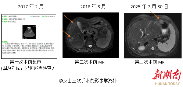 歷時(shí)8年3次手術(shù)，湘雅兩代醫(yī)者為肝癌女子“拆彈”