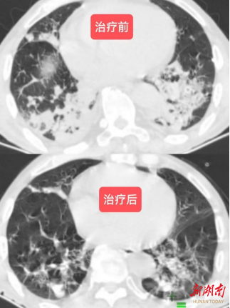 娄星区人民医院（妇幼保健院）救治罕见外源性类脂性肺炎患者
