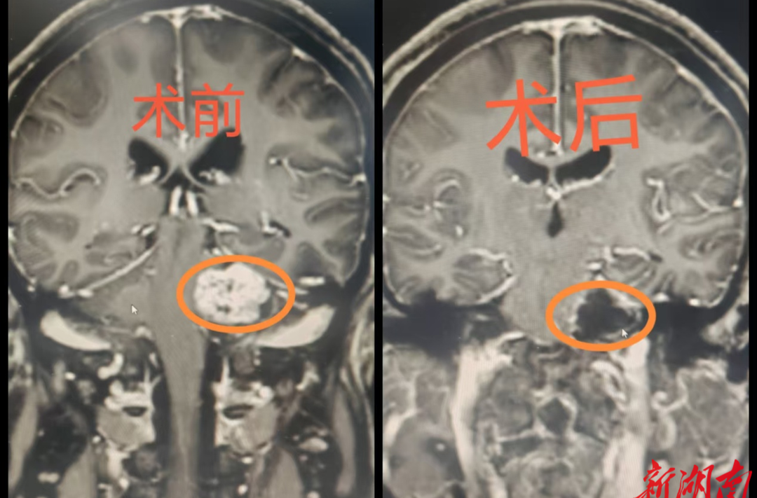 聽力驟降暗藏“瘤”險，精準摘瘤重啟“聲”活