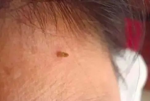 脖子上長(zhǎng)出的小肉粒，能揪嗎？