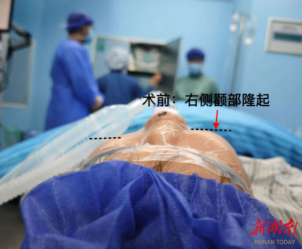 18歲少年面頰莫名隆起，竟是牙齒“迷路”鼻腔惹的禍