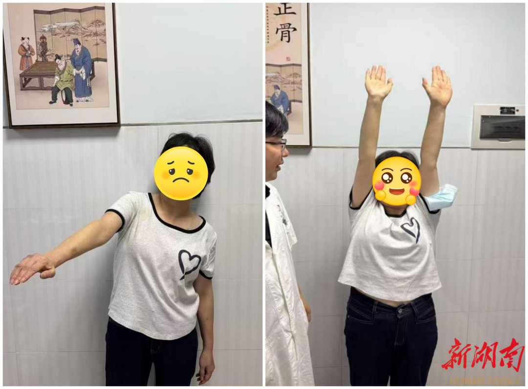 56歲阿姨遭“五十肩”折磨1年 中醫(yī)“針?biāo)山Y(jié)合”解頑疾