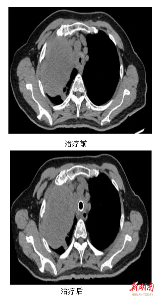 毫米之間再造“呼吸隧道”，腫瘤晚期老人重獲順暢呼吸