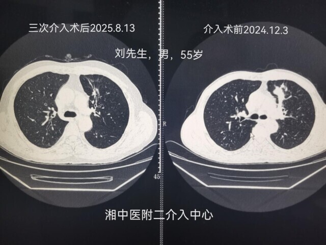“微創(chuàng)介入＋靶向治療”，讓晚期腫瘤患者擁抱新希望