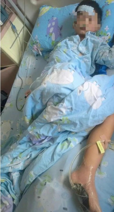 6歲男童光腳踩到死魚，次日高燒進ICU！醫(yī)生緊急提醒