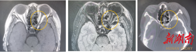 一場經(jīng)鼻腔的“視力救援”讓患者重見光明