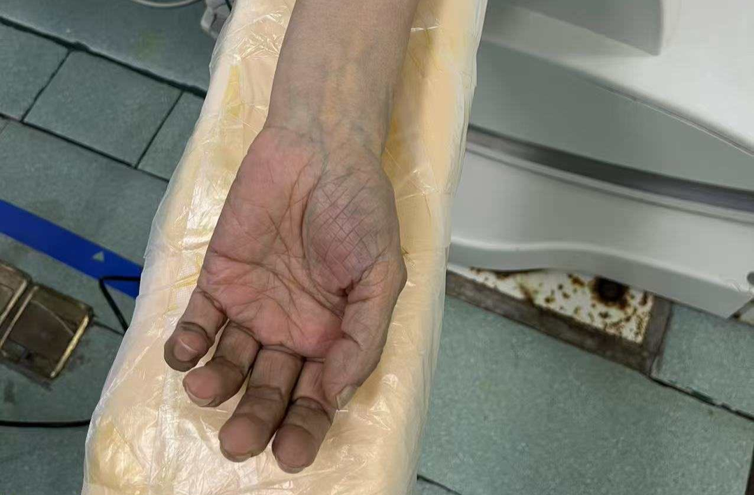 上肢突發(fā)麻木、乏力，79歲老人“手?！彪U截肢