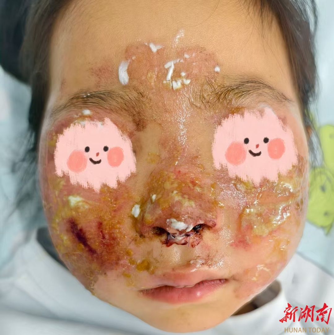 车速慢不等于安全！5岁女童坐副驾未系安全带被气囊击伤