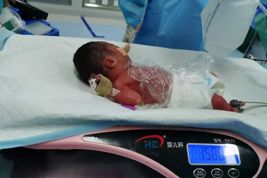 宫颈环扎术，助力极危孕妇顺利分娩
