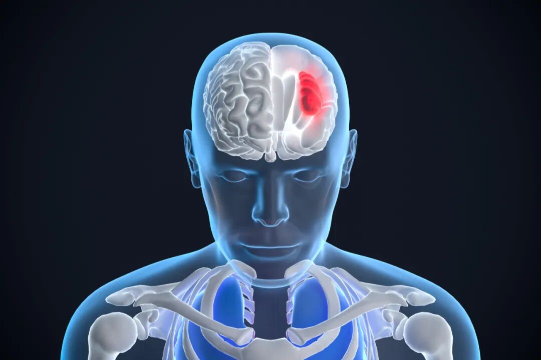 腦微出血是腦出血嗎，體檢發(fā)現(xiàn)后該怎么辦？