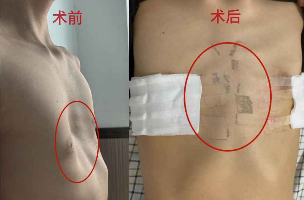不做“奥特曼”，还你挺拔的胸膛——记录泰和医院一天两台胸腔镜下漏斗胸NUSS手术