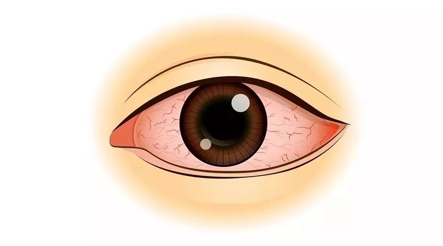 得過一次“紅眼病”后，就不會再得？中疾控提示