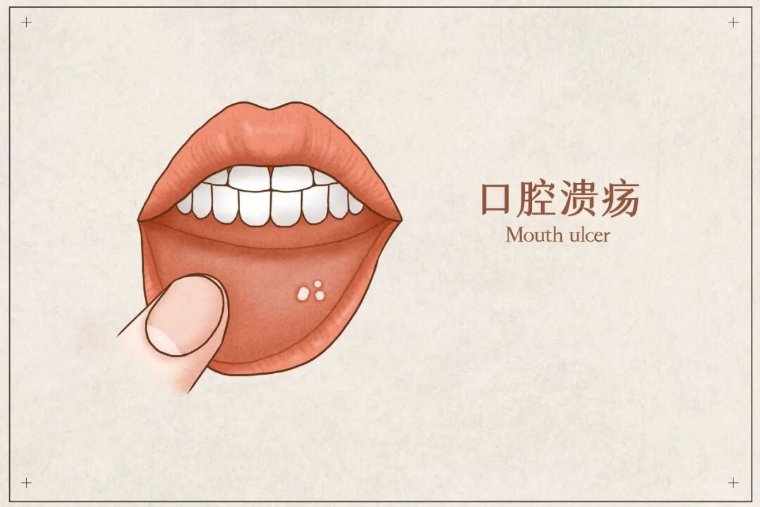 口腔潰瘍反復發(fā)作？?幫你破解！