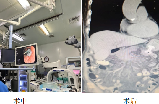 怀化首例！超级微创解决消化道梗阻难题
