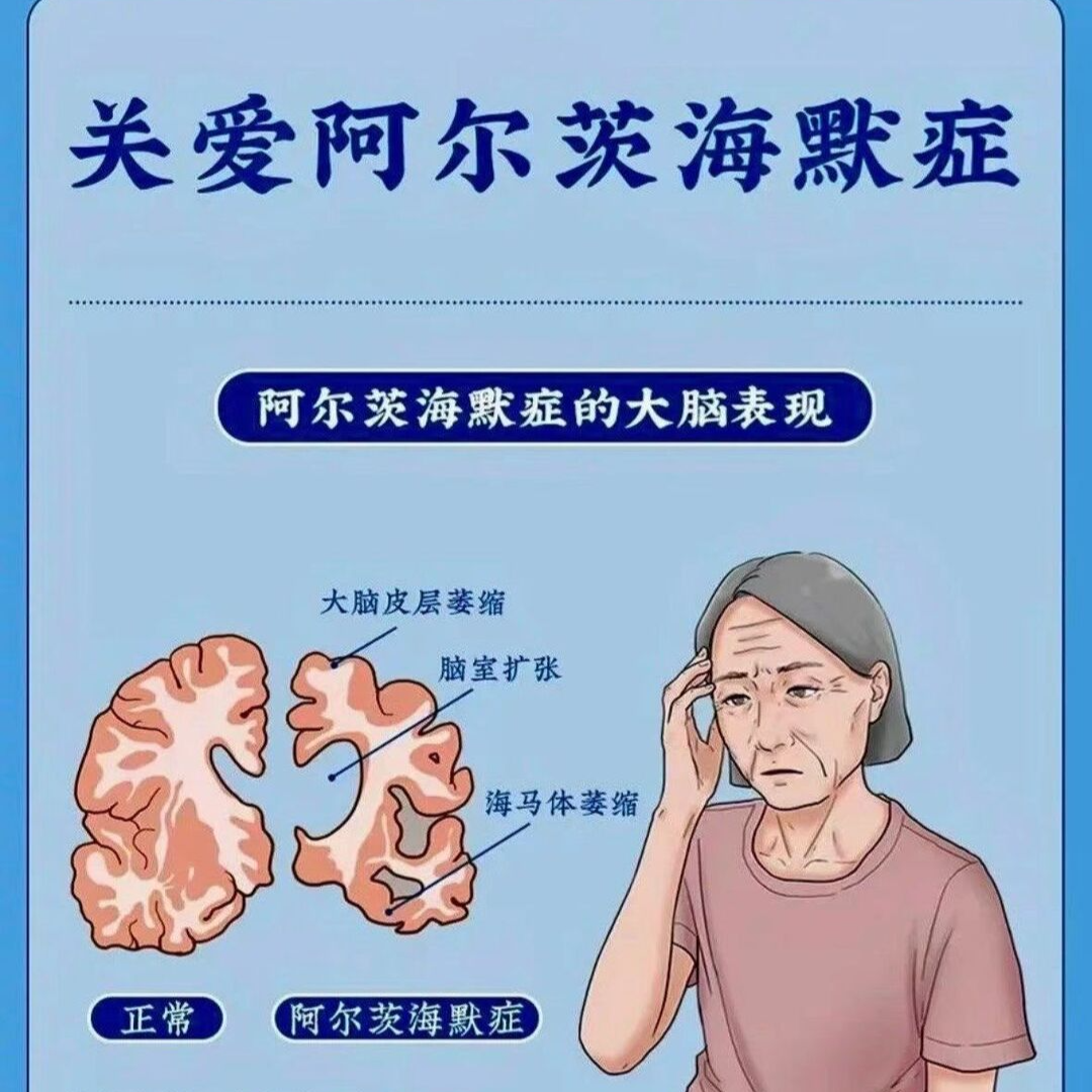 温和老师突然变“糊涂”，医生教您“识别”阿尔茨海默病