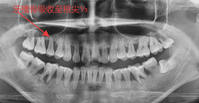 全国爱牙日：小心！刷牙出血正在悄悄“偷走”你的牙齿