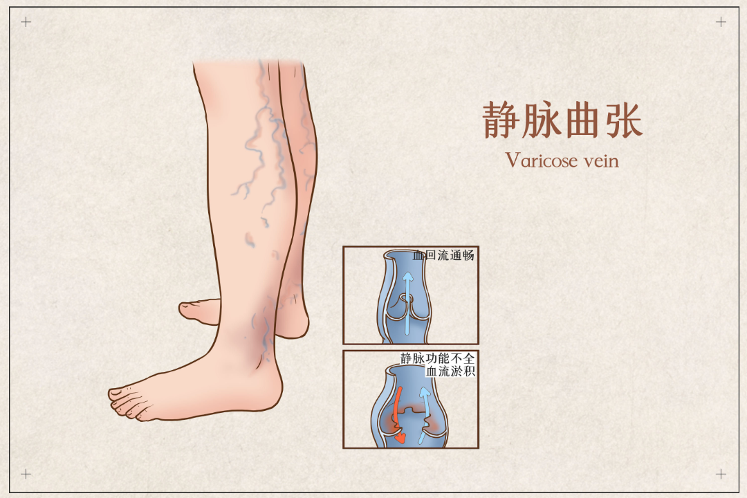 “蚯蚓腿”又丑又痛？微创技术帮你轻松摆脱
