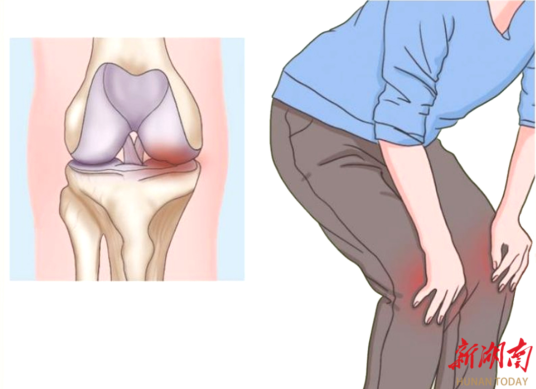 秋季骨关节炎高发？做好这五点轻松应对