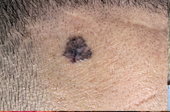 长了十多年的黑痣竟然变成癌症，这几种“痣”要警惕！