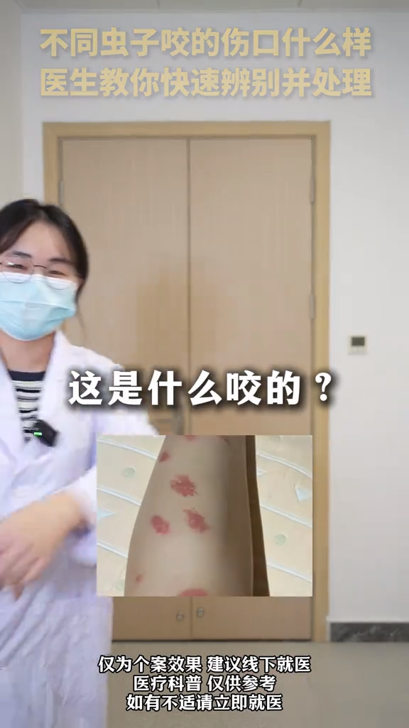 被虫咬了别慌！急诊科医生教你一眼分清不同虫咬伤口