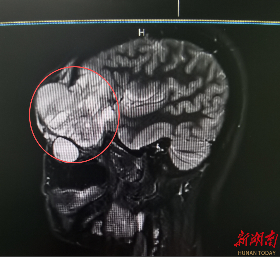 32岁女子容貌变形、左眼几近失明！多学科联动拆除“颅底炸弹”
