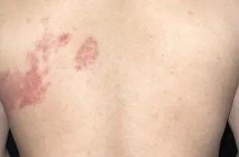 “最疼皮肤病”进入高发期 出现这些疼痛信号别大意