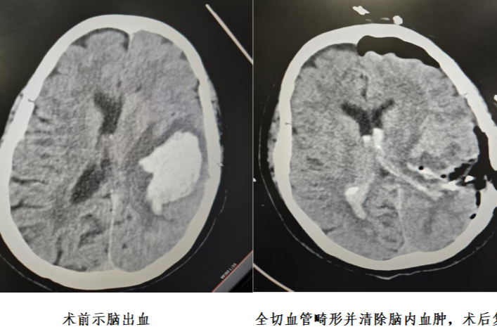湘桂黔接边区域首例高难度脑动静脉血管畸形切除术成功实施