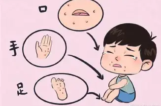 中疾控提示：孩子得了手足口病，出现这些症状应迅速就医