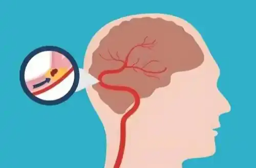 周末·健康丨气温骤降 一个动作教你科学预防脑卒中