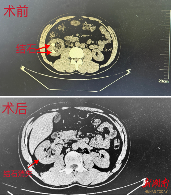 “我就是冲着你们的技术来的！”大湾区患者点赞郴州市第四人民医院医技医德