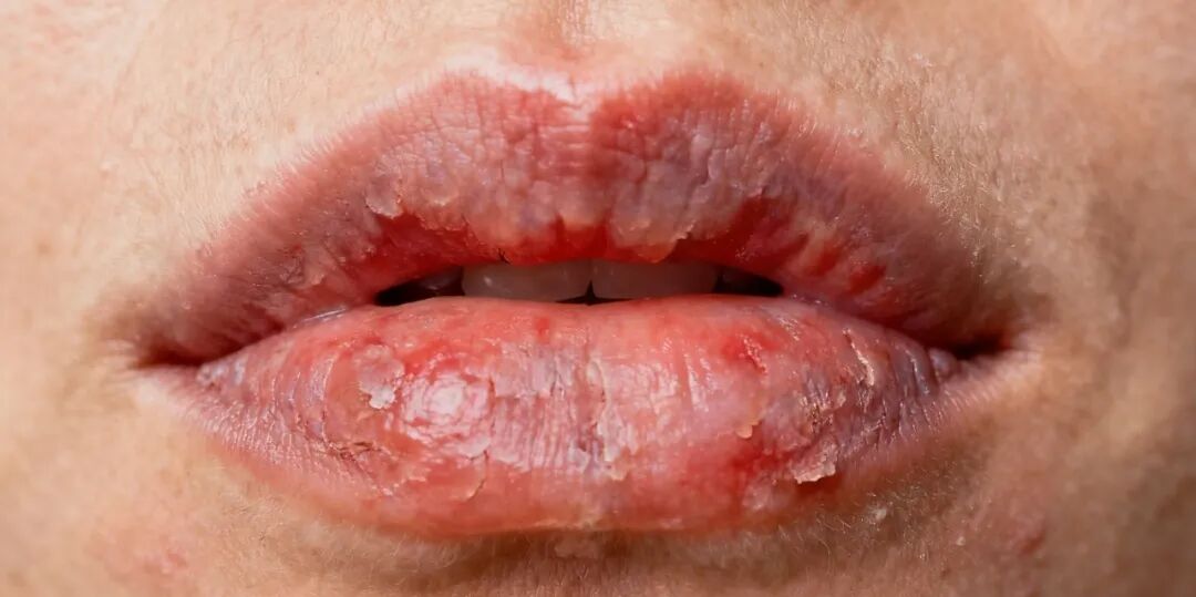 一到换季嘴唇就爆皮？别再怪喝水少了！医生提醒：可能是这病在搞鬼