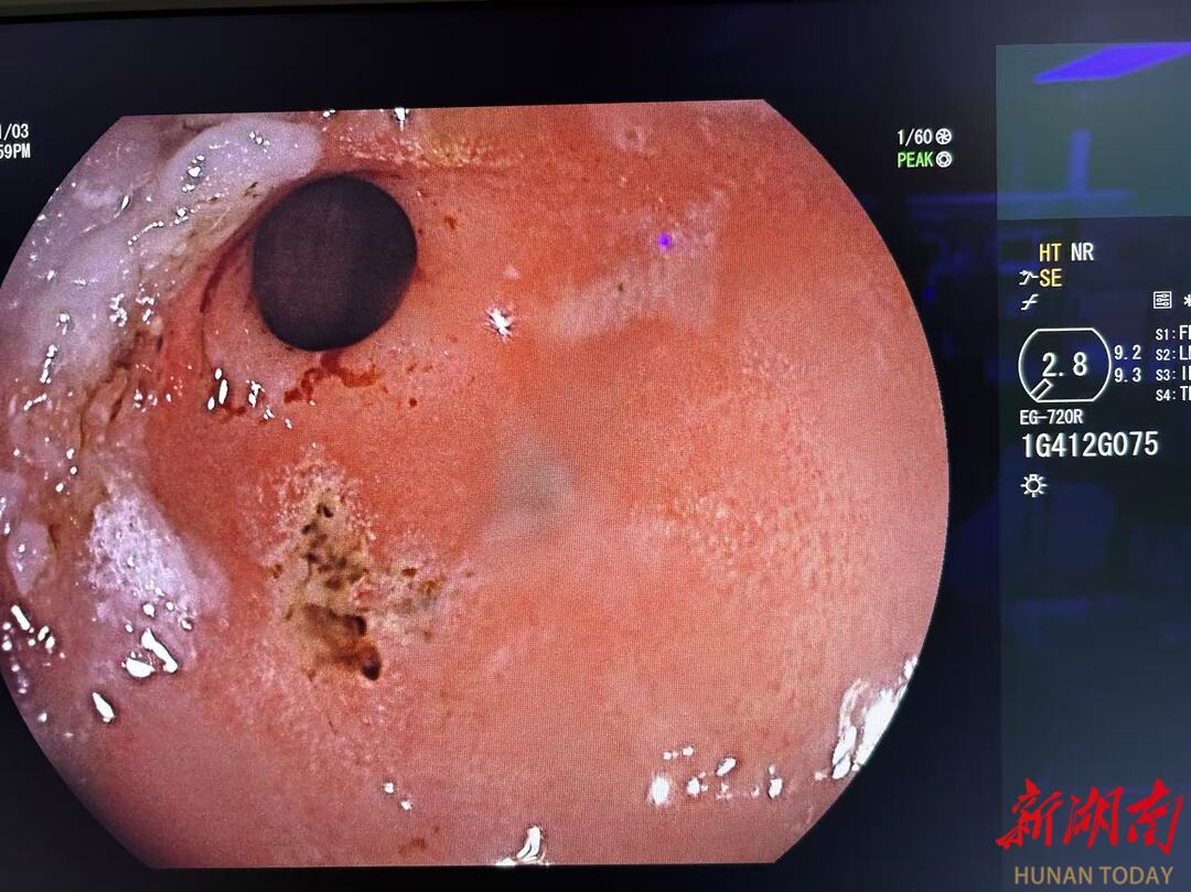 20天内收治4例！吞服电池，严重者危及生命！